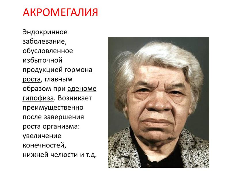 АКРОМЕГАЛИЯ Эндокринное заболевание, обусловленное избыточной продукцией гормона роста, главным образом при аденоме гипофиза