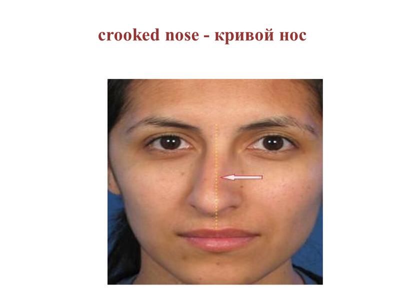 crooked nose - кривой нос