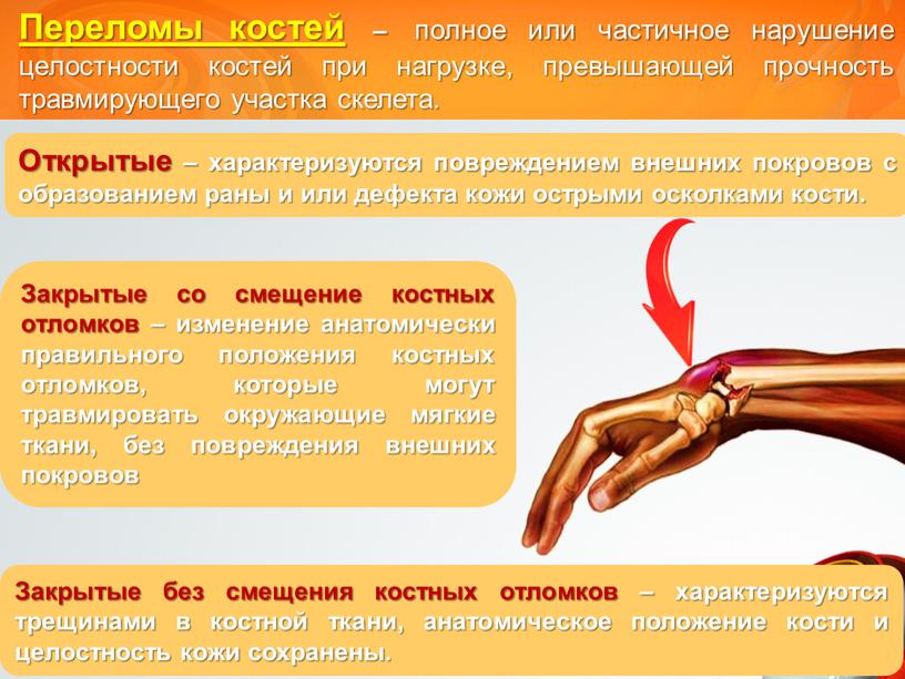 Переломы костей – полное или частичное нарушение целостности костей при нагрузке, превышающей прочность травмирующего участка скелета