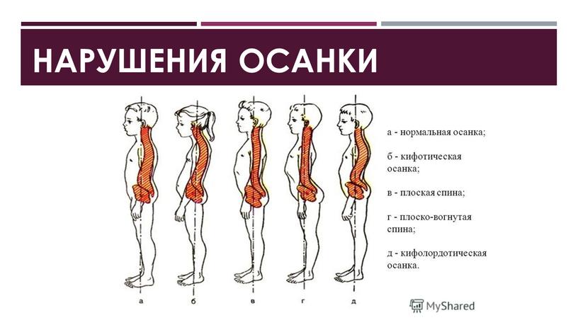 Тестовая карта для выявления нарушений осанки