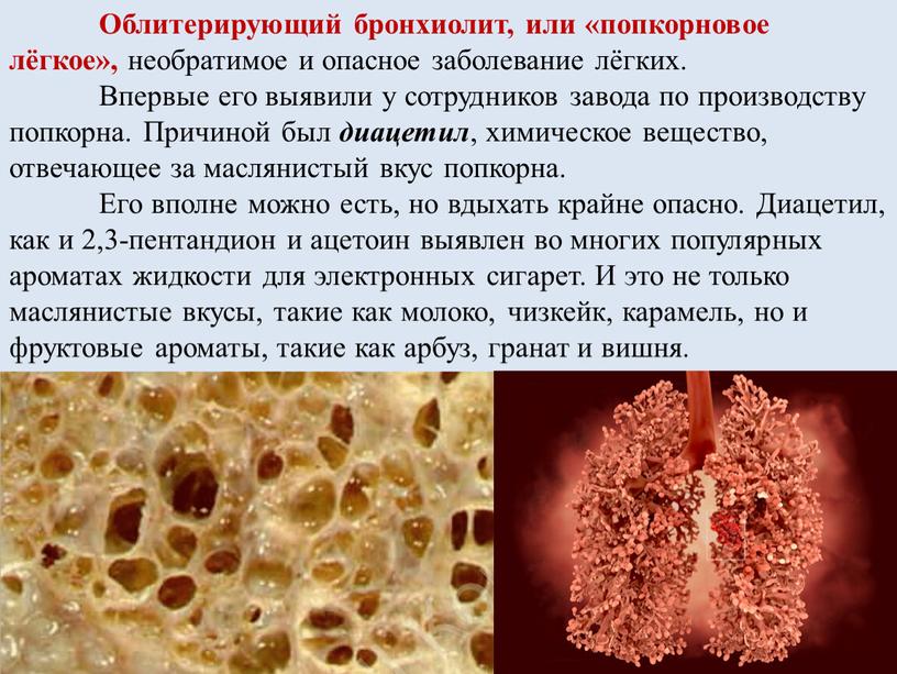 Облитерирующий бронхиолит, или «попкорновое лёгкое», необратимое и опасное заболевание лёгких