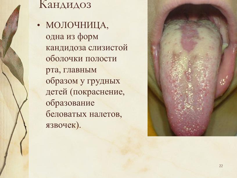 Кандидоз МОЛОЧНИЦА, одна из форм кандидоза слизистой оболочки полости рта, главным образом у грудных детей (покраснение, образование беловатых налетов, язвочек)