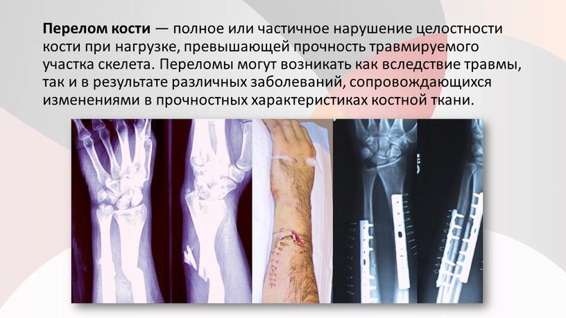 Перелом кости — полное или частичное нарушение целостности кости при нагрузке, превышающей прочность травмируемого участка скелета