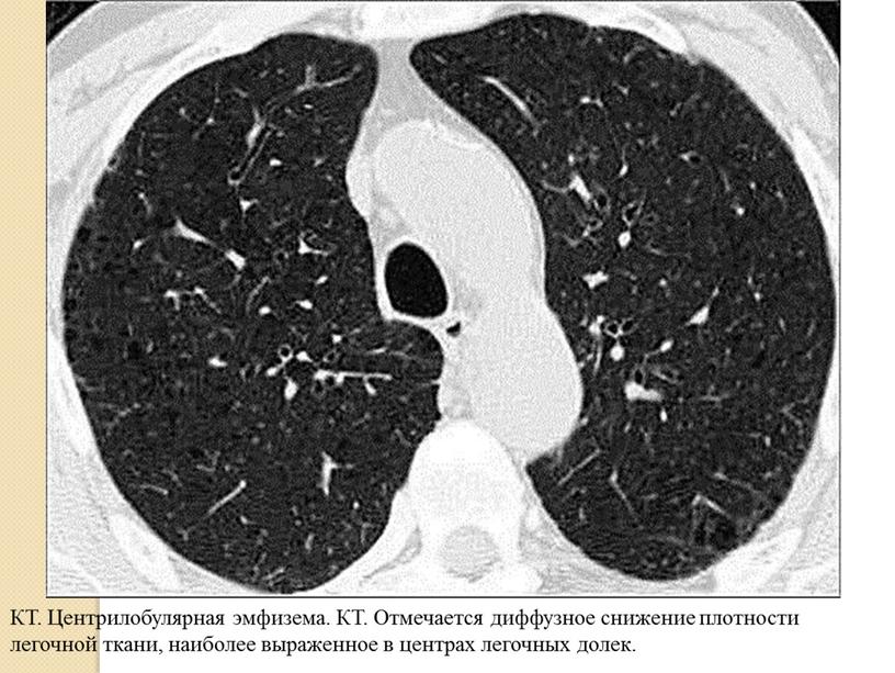 КТ. Центрилобулярная эмфизема.