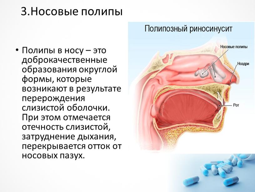 Носовые полипы Полипы в носу – это доброкачественные образования округлой формы, которые возникают в результате перерождения слизистой оболочки