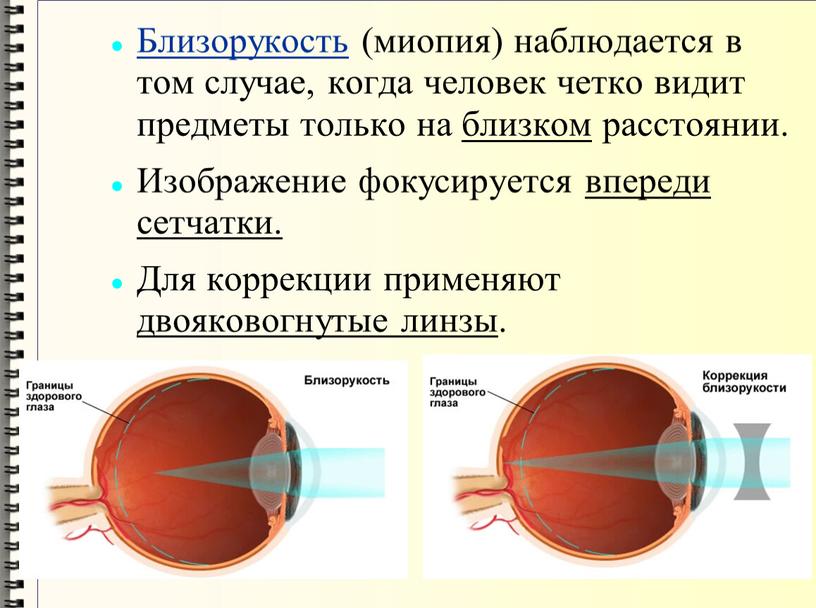 Близорукость (миопия) наблюдается в том случае, когда человек четко видит предметы только на близком расстоянии