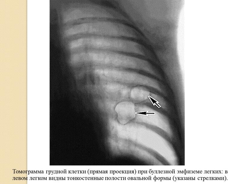Томограмма грудной клетки (прямая проекция) при буллезной эмфиземе легких: в левом легком видны тонкостенные полости овальной формы (указаны стрелками)