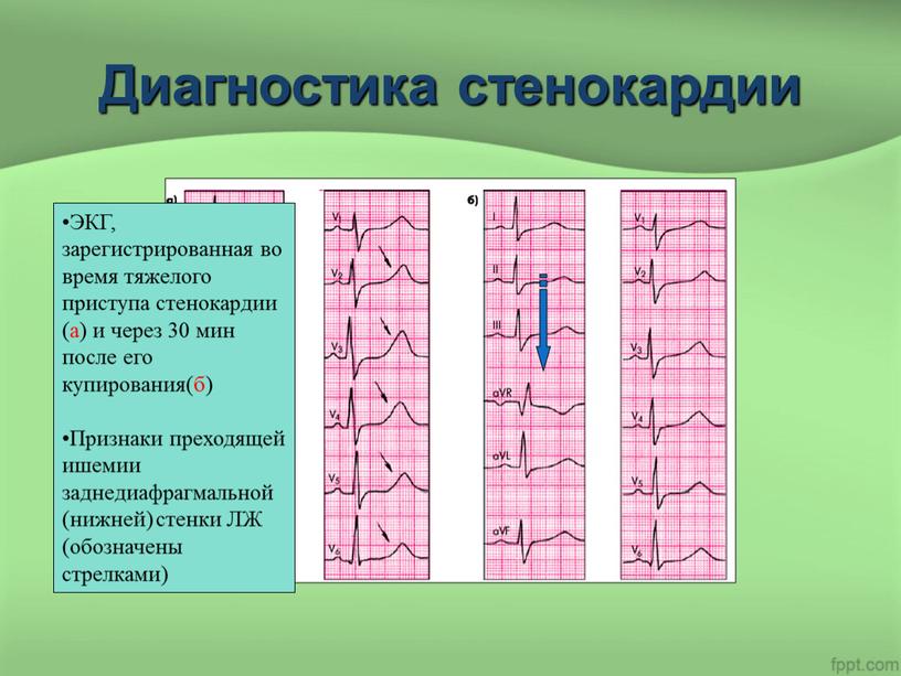 Диагностика стенокардии ЭКГ, зарегистрированная во время тяжелого приступа стенокардии (а) и через 30 мин после его купирования(б)