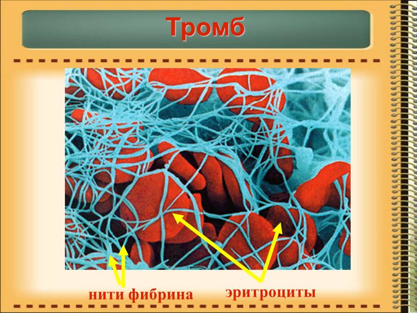 нити фибрина эритроциты Тромб