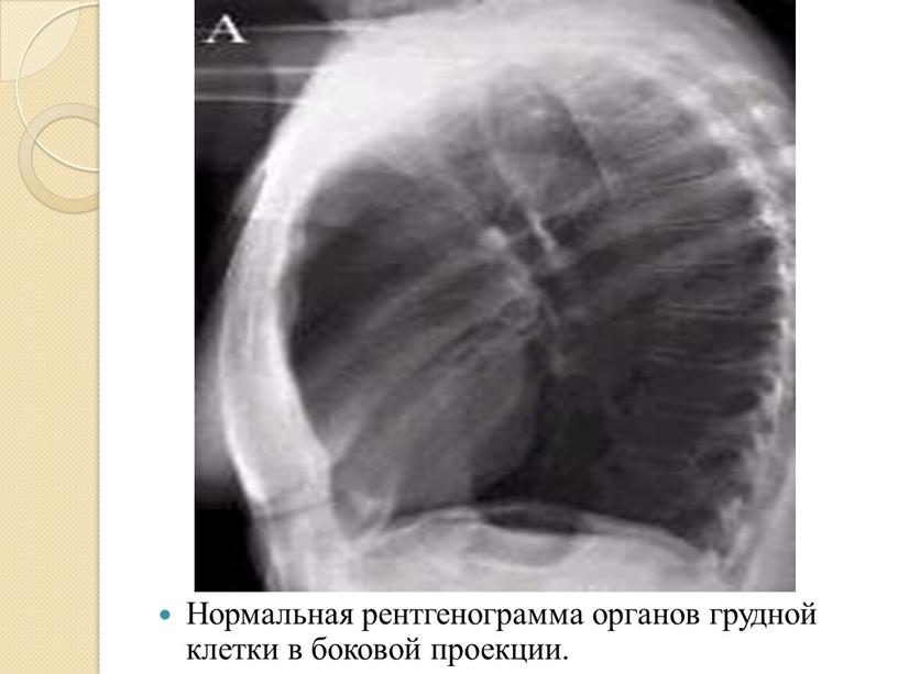 Нормальная рентгенограмма органов грудной клетки в боковой проекции