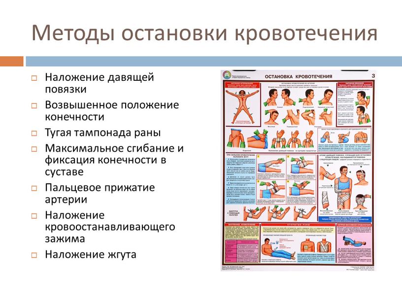 Методы остановки кровотечения Наложение давящей повязки