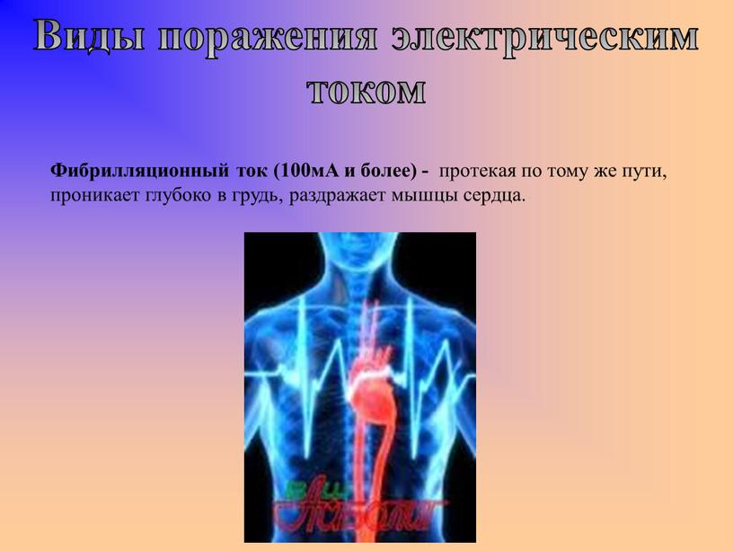 Фибрилляционный ток (100мА и более) - протекая по тому же пути, проникает глубоко в грудь, раздражает мышцы сердца