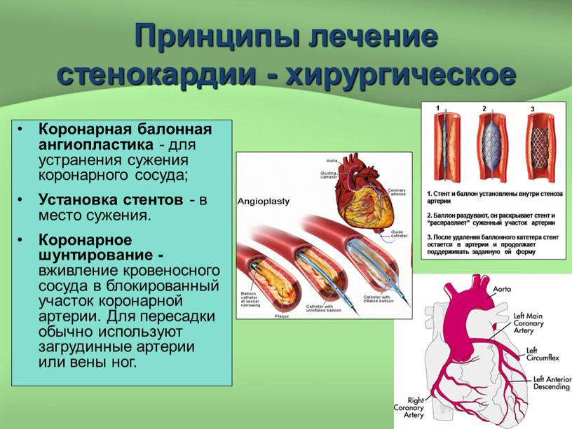 Принципы лечение стенокардии - хирургическое