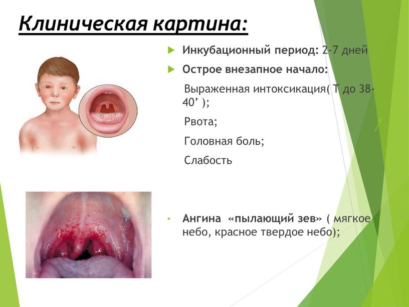 Клиническая картина: Инкубационный период: 2-7 дней