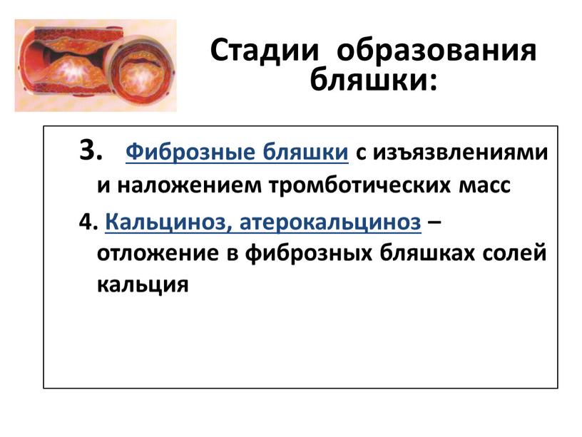 Фиброзные бляшки с изъязвлениями и наложением тромботических масс 4