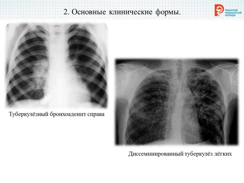 Основные клинические формы. Диссеминированный туберкулёз лёгких