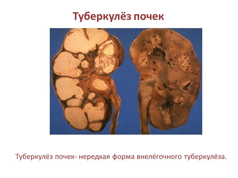 Туберкулёз почек Туберкулёз почек- нередкая форма внелёгочного туберкулёза