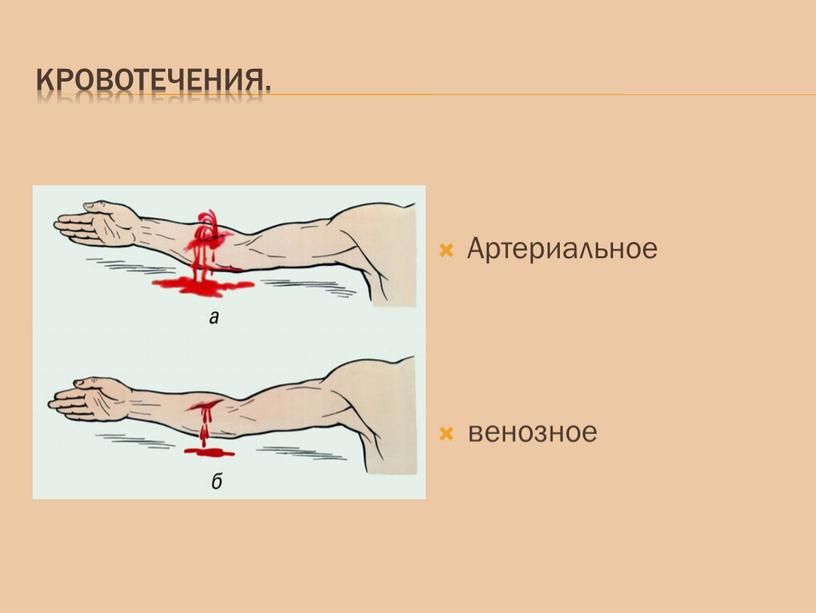 Кровотечения. Артериальное венозное