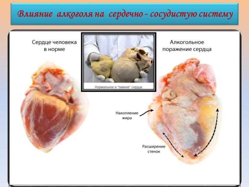 Влияние алкоголя на сердечно - сосудистую систему