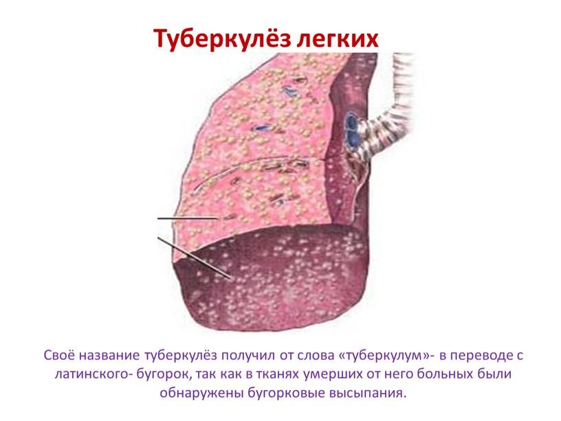 Туберкулёз легких Своё название туберкулёз получил от слова «туберкулум»- в переводе с латинского- бугорок, так как в тканях умерших от него больных были обнаружены бугорковые…