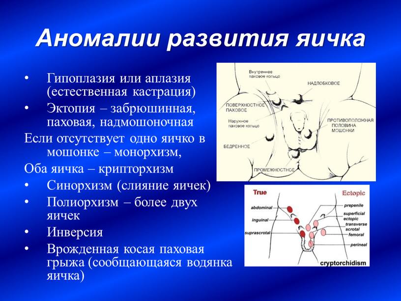 Аномалии развития яичка Гипоплазия или аплазия (естественная кастрация)