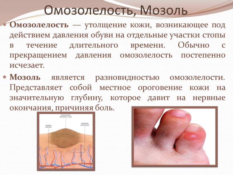 Омозолелость, Мозоль Омозолелость — утолщение кожи, возникающее под действием давления обуви на отдельные участки стопы в течение длительного времени