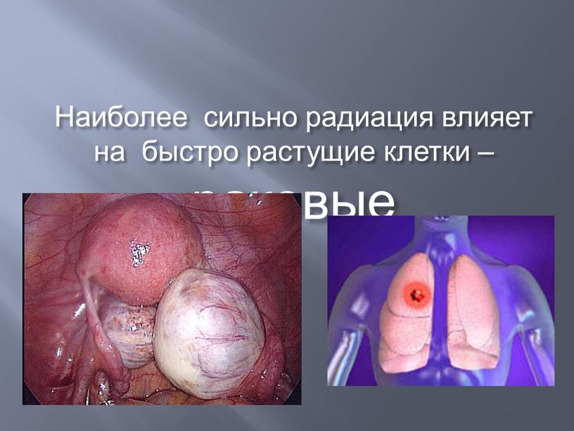 Наиболее сильно радиация влияет на быстро растущие клетки – раковые