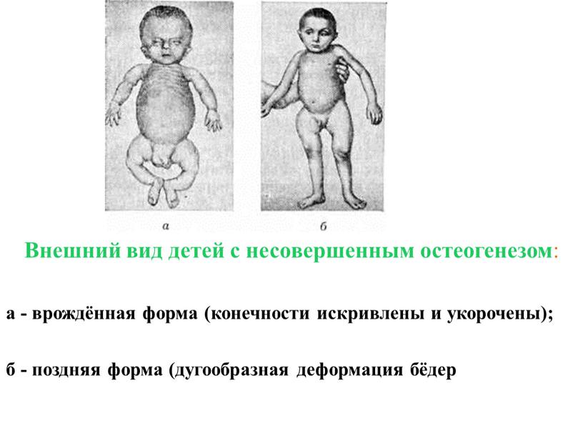 Внешний вид детей с несовершенным остеогенезом : а - врождённая форма (конечности искривлены и укорочены); б - поздняя форма (дугообразная деформация бёдер