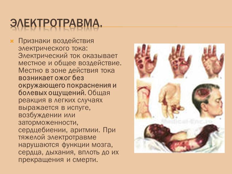 Электротравма. Признаки воздействия электрического тока: