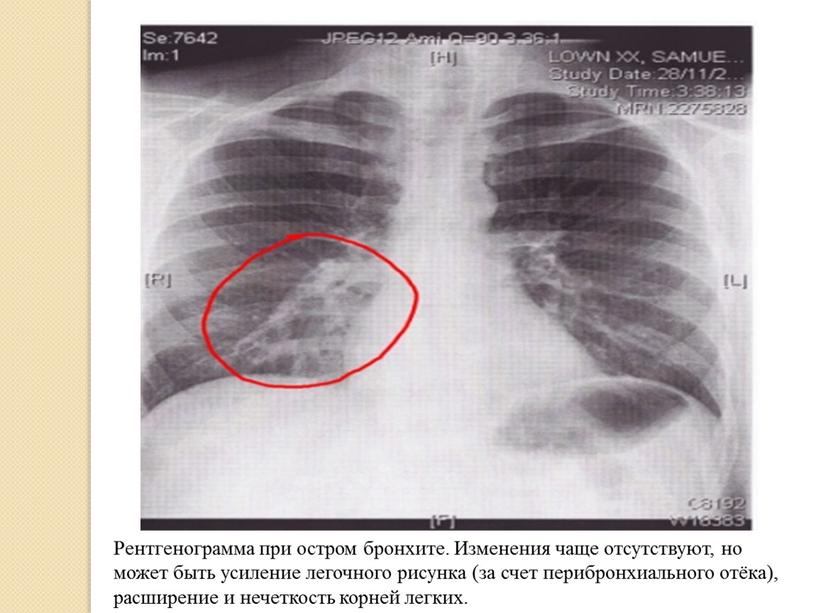 Рентгенограмма при остром бронхите