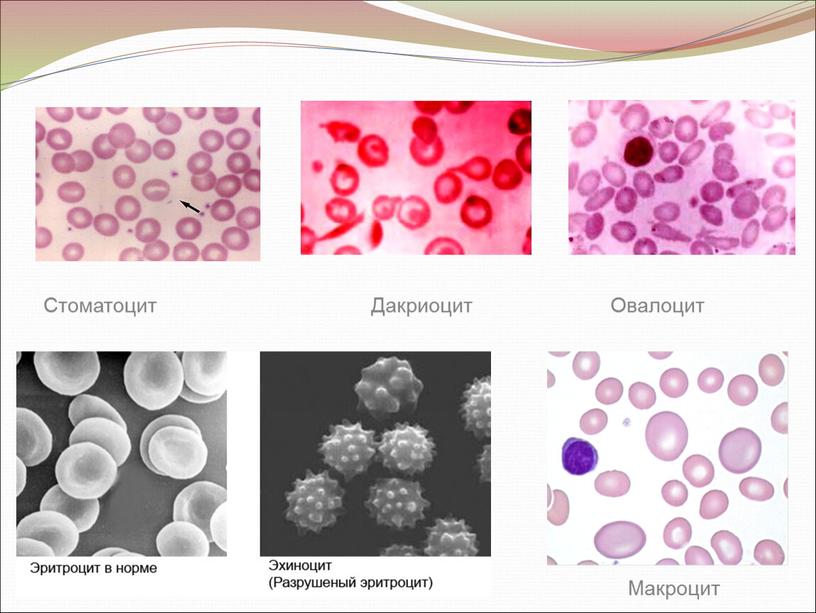 Стоматоцит Макроцит Дакриоцит Овалоцит