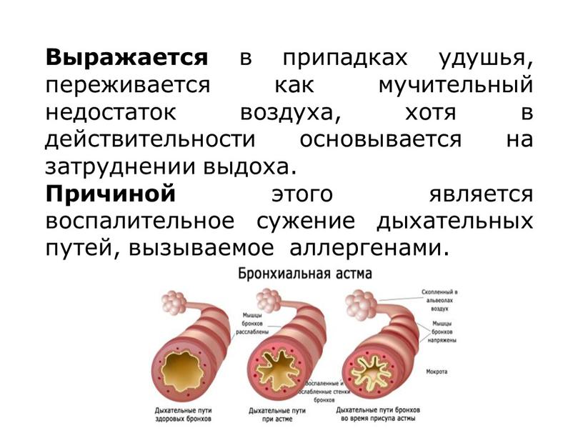 Выражается в припадках удушья, переживается как мучительный недостаток воздуха, хотя в действительности основывается на затруднении выдоха