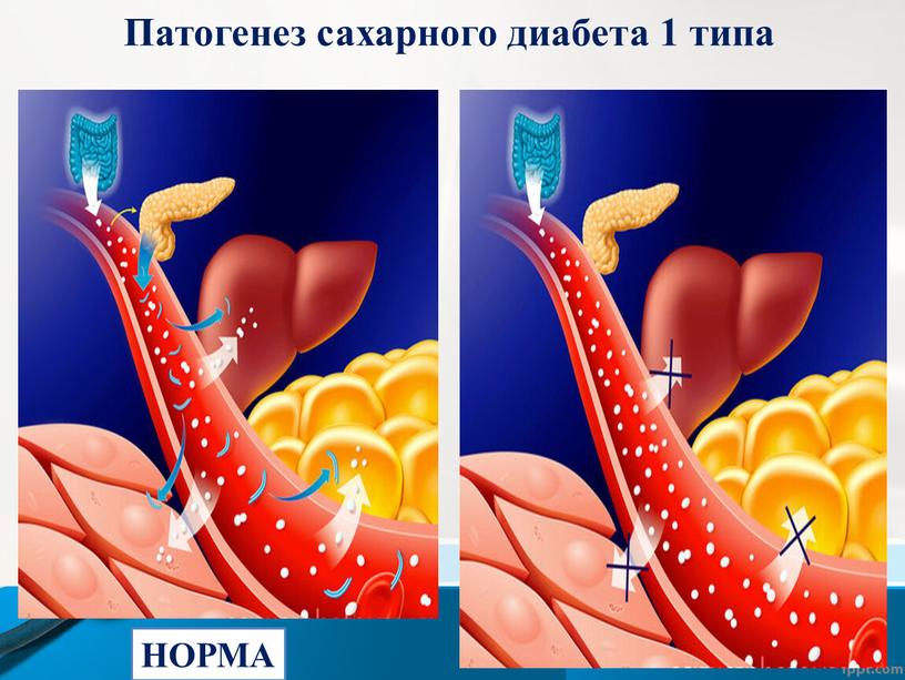 НОРМА Патогенез сахарного диабета 1 типа