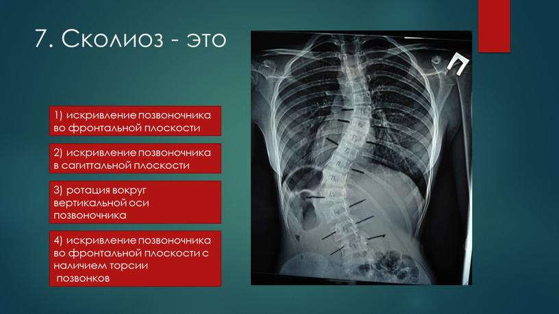 Сколиоз - это 2) искривление позвоночника в сагиттальной плоскости 4) искривление позвоночника во фронтальной плоскости с наличием торсии позвонков 3) ротация вокруг вертикальной оси позвоночника…