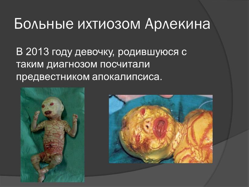 Больные ихтиозом Арлекина В 2013 году девочку, родившуюся с таким диагнозом посчитали предвестником апокалипсиса
