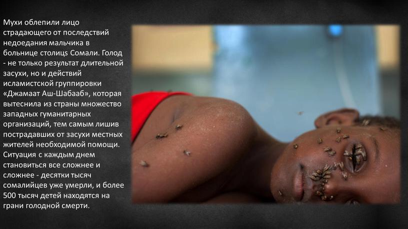 Мухи облепили лицо страдающего от последствий недоедания мальчика в больнице столицs