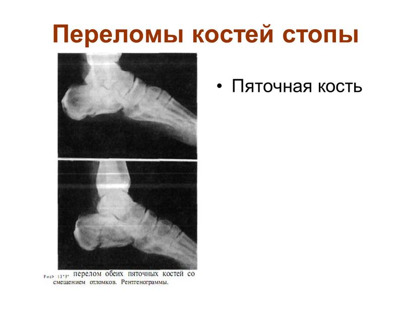 Переломы костей стопы Пяточная кость