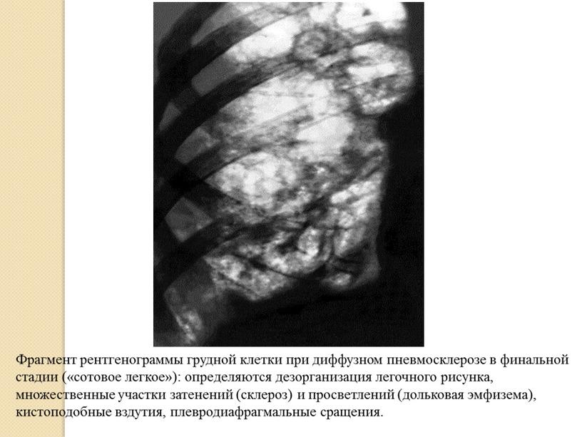 Фрагмент рентгенограммы грудной клетки при диффузном пневмосклерозе в финальной стадии («сотовое легкое»): определяются дезорганизация легочного рисунка, множественные участки затенений (склероз) и просветлений (дольковая эмфизема), кистоподобные…
