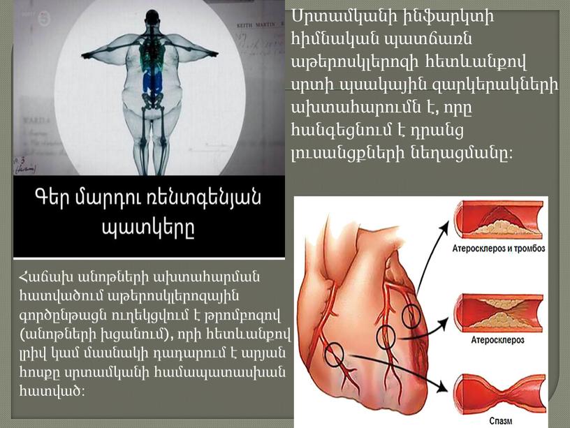 Սրտամկանի ինֆարկտի հիմնական պատճառն աթերոսկլերոզի հետևանքով սրտի պսակային զարկերակների ախտահարումն է, որը հանգեցնում է դրանց լուսանցքների նեղացմանը։ Հաճախ անոթների ախտահարման հատվածում աթերոսկլերոզային գործընթացն ուղեկցվում է…