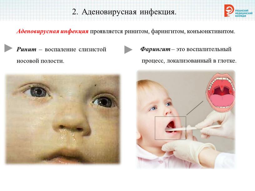 Аденовирусная инфекция. Аденовирусная инфекция проявляется ринитом, фарингитом, конъюнктивитом