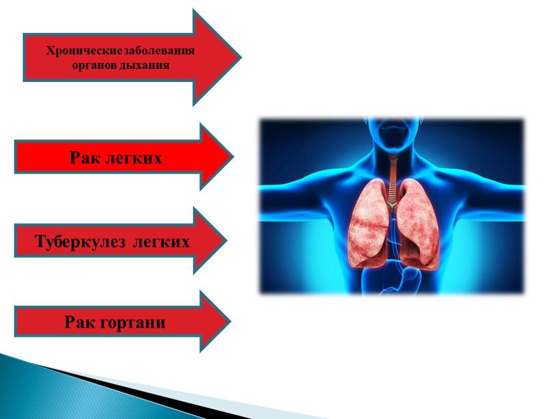 Рак гортани Хронические заболевания органов дыхания