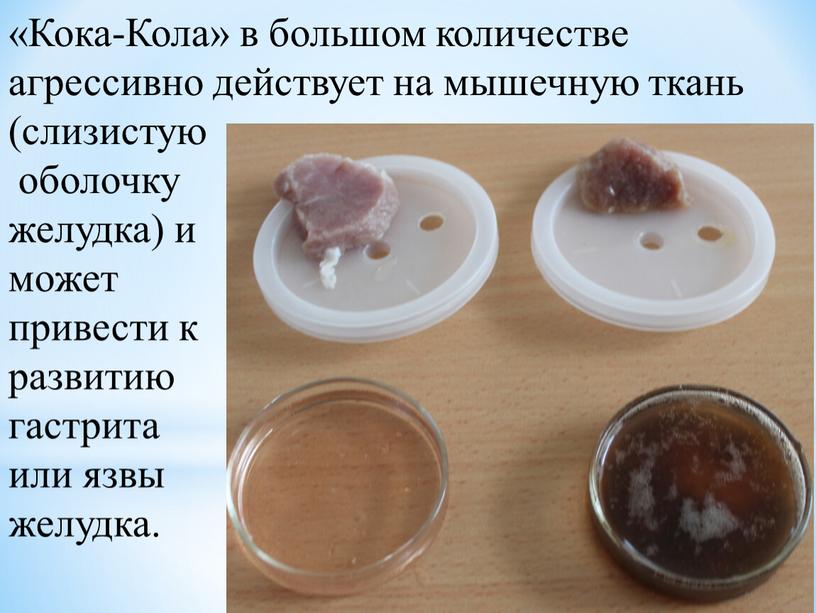 Кока-Кола» в большом количестве агрессивно действует на мышечную ткань (слизистую оболочку желудка) и может привести к развитию гастрита или язвы желудка