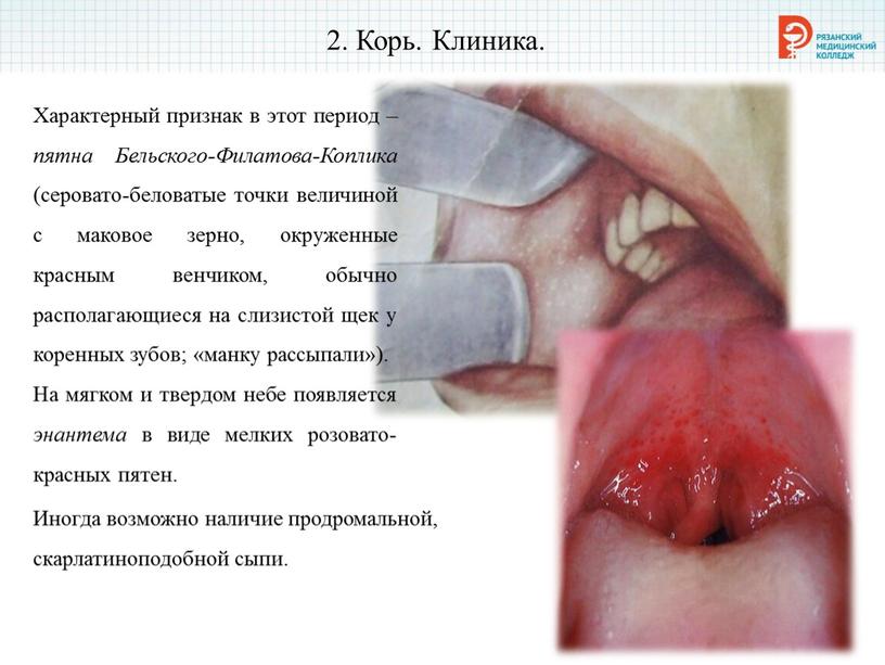 Корь. Клиника. Характерный признак в этот период – пятна