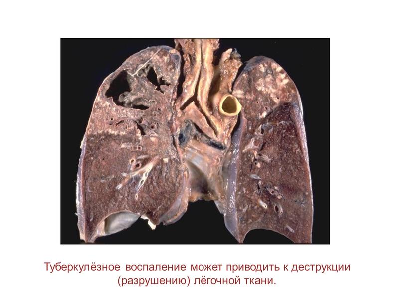 Туберкулёзное воспаление может приводить к деструкции (разрушению) лёгочной ткани