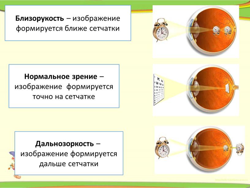 Близорукость – изображение формируется ближе сетчатки