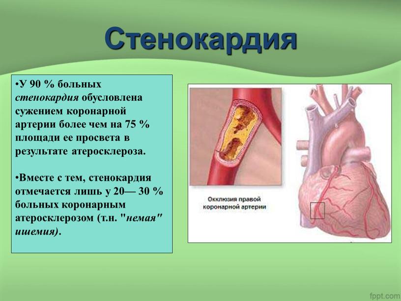 Стенокардия У 90 % больных стенокардия обусловлена сужением коронарной артерии более чем на 75 % площади ее просвета в результате атеросклероза