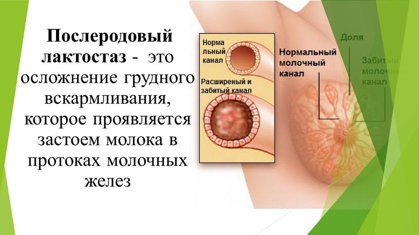 Послеродовый лактостаз - это осложнение грудного вскармливания, которое проявляется застоем молока в протоках молочных желез