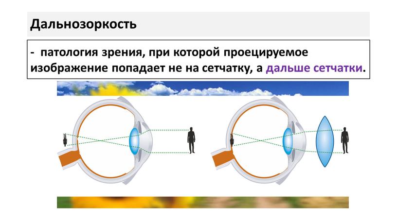 Дальнозоркость - патология зрения, при которой проецируемое изображение попадает не на сетчатку, а дальше сетчатки