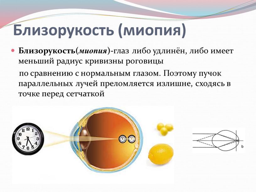 Близорукость( миопия )- глаз либо удлинён, либо имеет меньший радиус кривизны роговицы по сравнению с нормальным глазом