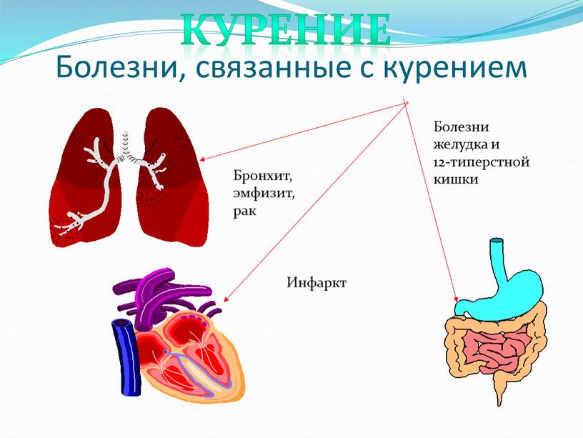 Болезни, связанные с курением Бронхит, эмфизит, рак